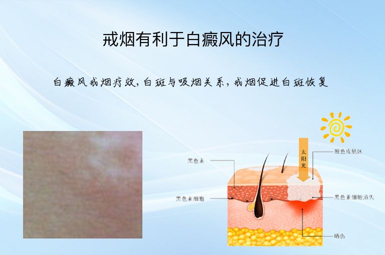 戒烟有利于白癜风的治疗”