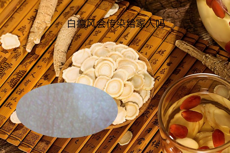 白癜风会传染给家人吗”