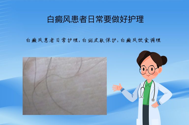 白癜风患者日常要做好护理”