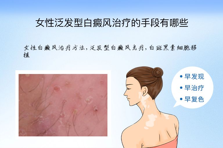 女性泛发型白癜风治疗的手段有哪些”