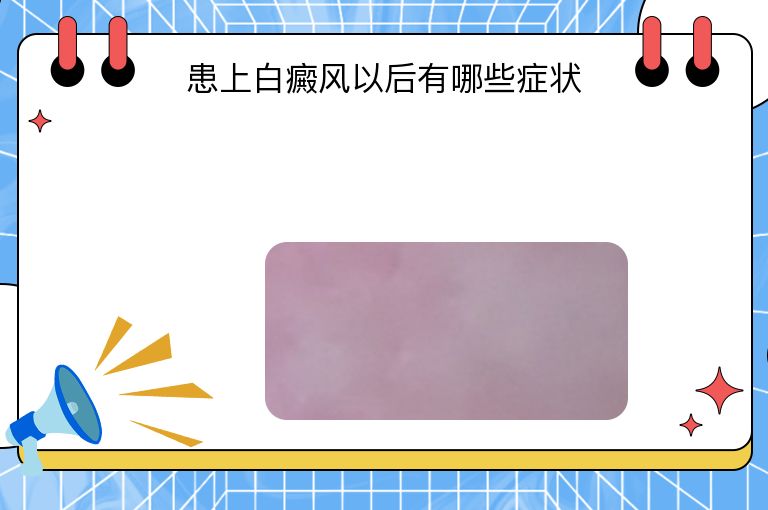 患上白癜风以后有哪些症状