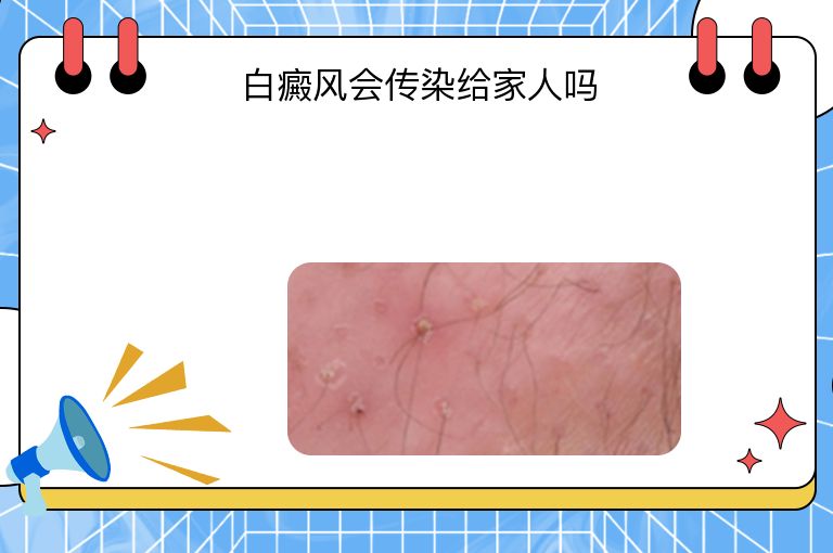 白癜风会传染给家人吗”
