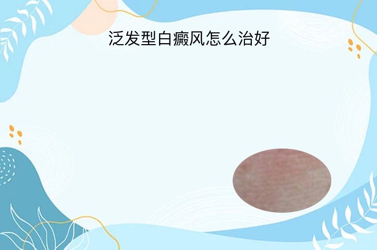 泛发型白癜风怎么治好”