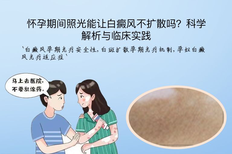 怀孕期间照光能让白癜风不扩散吗?科学解析与临床实践”