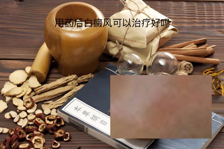 用药后白癜风可以治疗好吗”