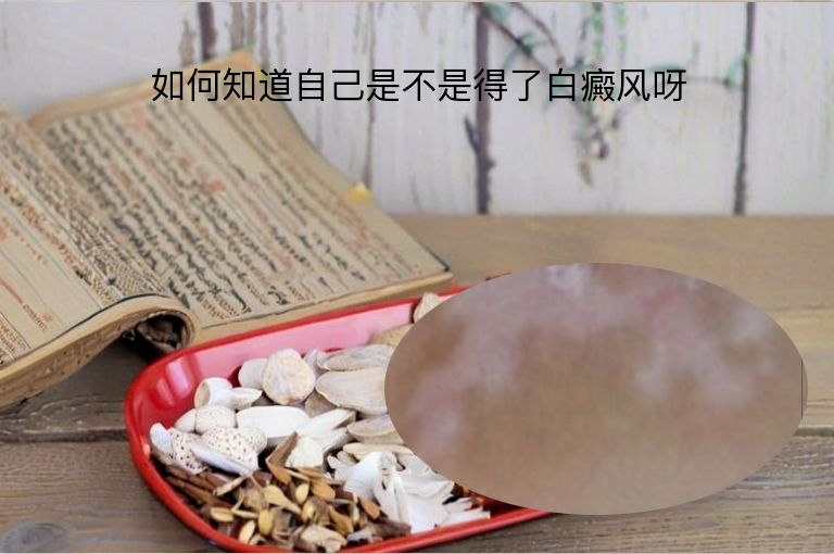如何知道自己是不是得了白癜风呀