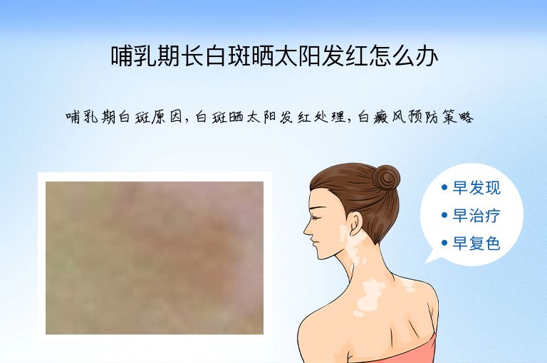 哺乳期长白斑晒太阳发红怎么办”