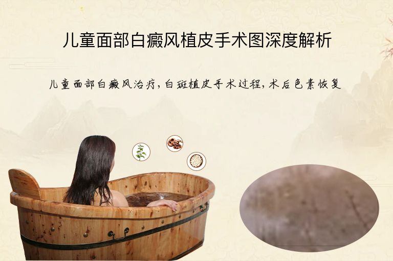 儿童面部白癜风植皮手术图深度解析”