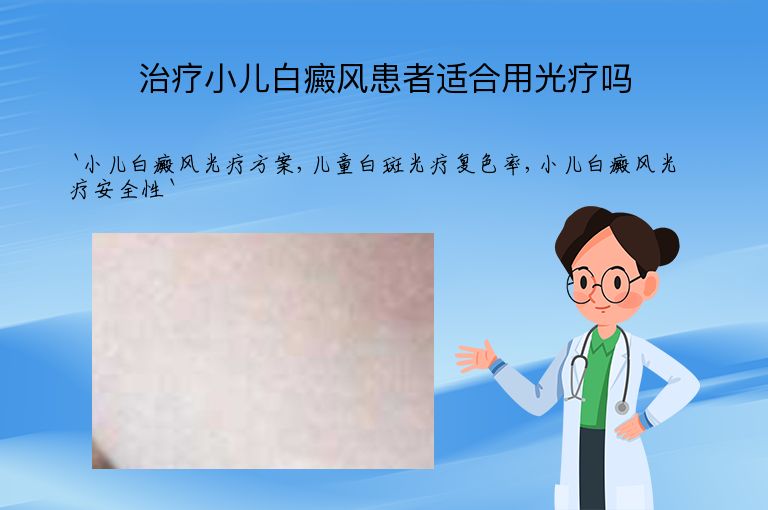 治疗小儿白癜风患者适合用光疗吗