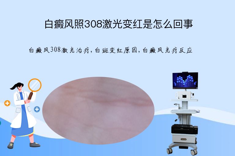 白癜风照308激光变红是怎么回事”