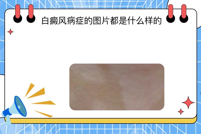 白癜风病症的图片都是什么样的