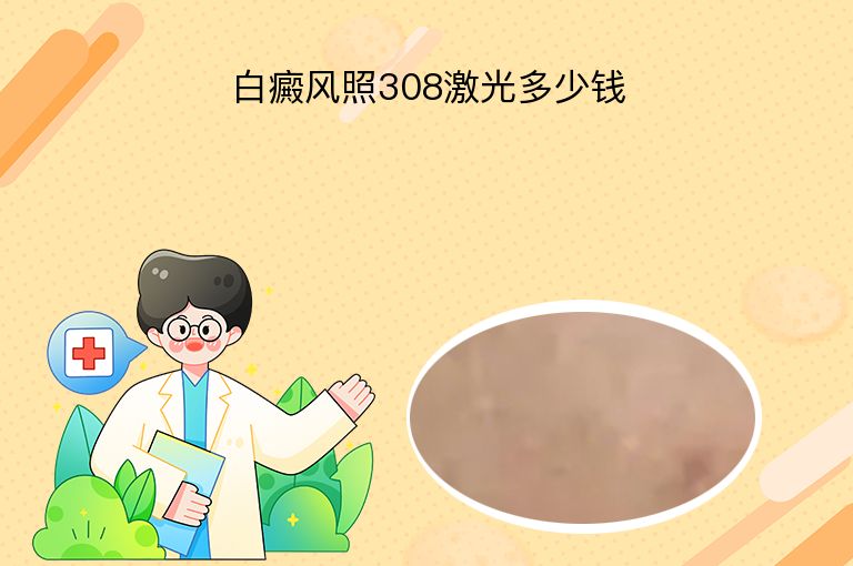 白癜风照308激光多少钱”