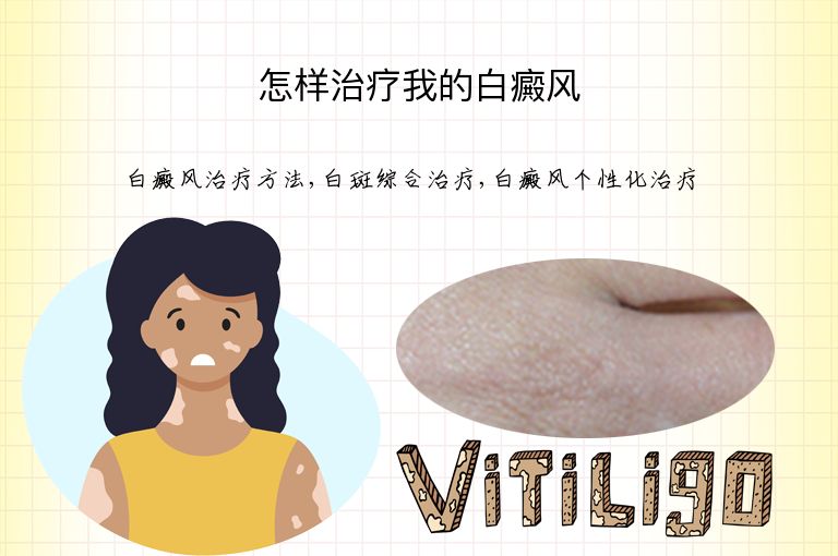 怎样治疗我的白癜风”