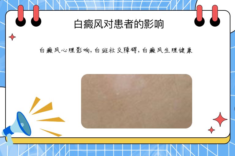 白癜风对患者的影响”