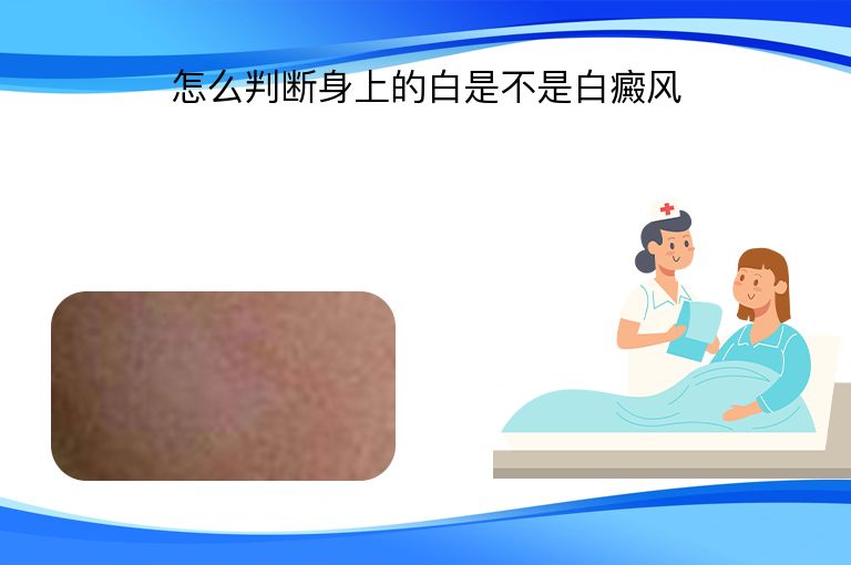 怎么判断身上的白是不是白癜风