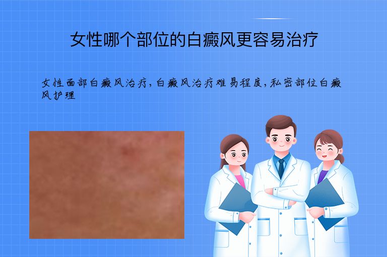 女性哪个部位的白癜风更容易治疗”