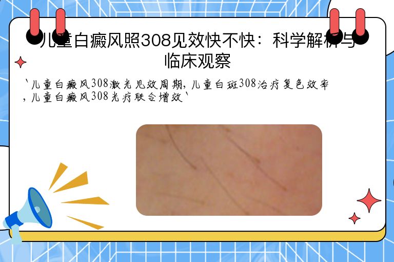 儿童白癜风照308见效快不快：科学解析与临床观察