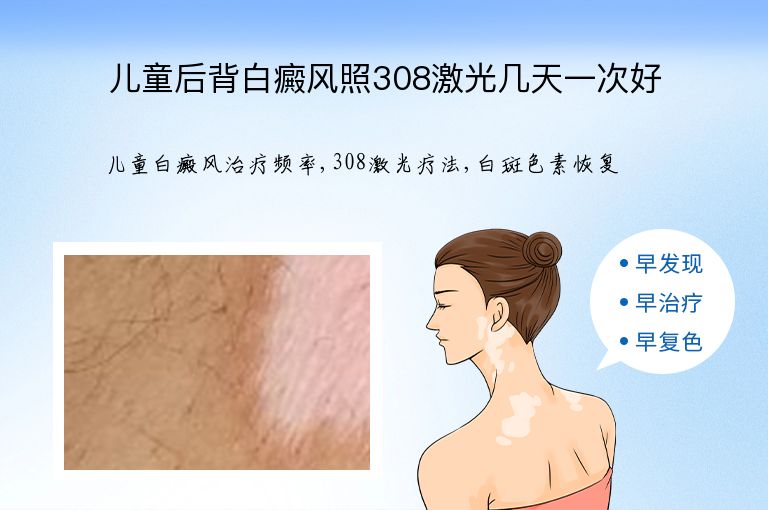 儿童后背白癜风照308激光几天一次好”