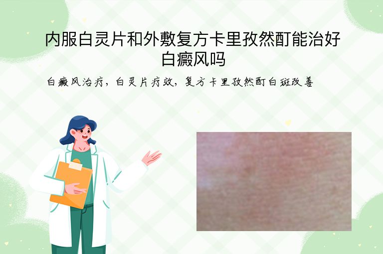 内服白灵片和外敷复方卡里孜然酊能治好白癜风吗”