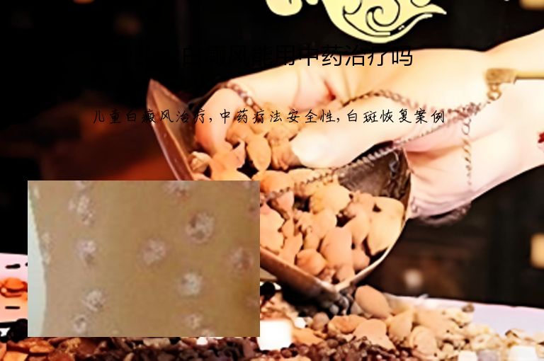 儿童白癜风能用中药治疗吗”