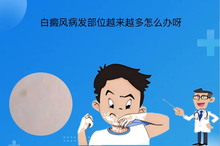白癜风病发部位越来越多怎么办呀”