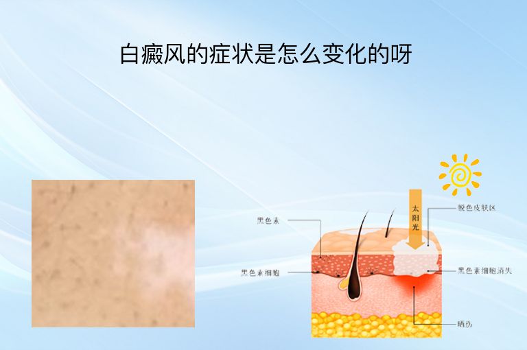 白癜风的症状是怎么变化的呀