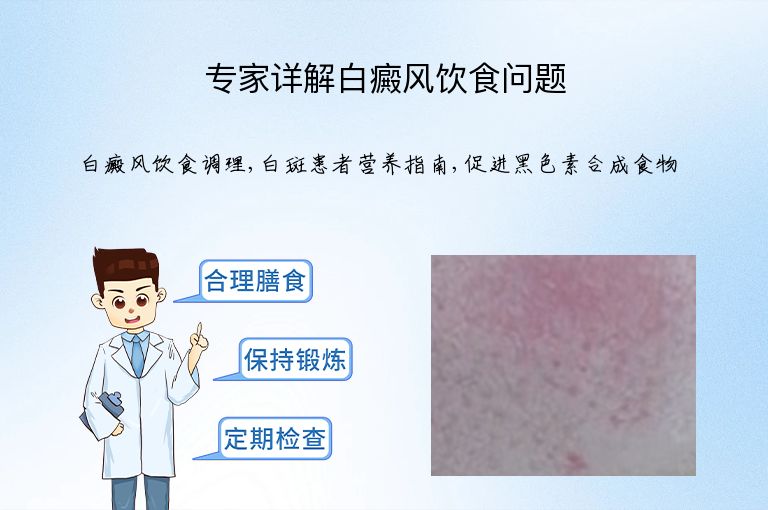 专家详解白癜风饮食问题”