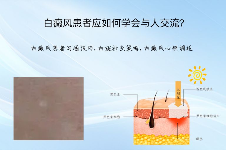 白癜风患者应如何学会与人交流？”
