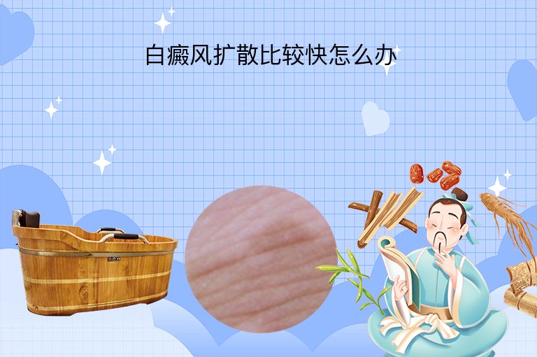 白癜风扩散比较快怎么办