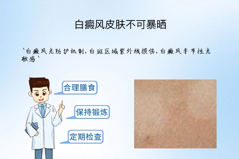 白癜风皮肤不可暴晒