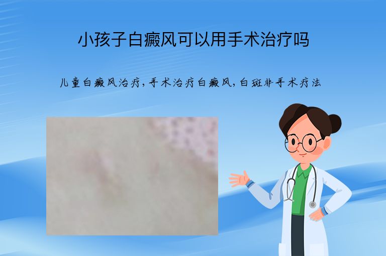 小孩子白癜风可以用手术治疗吗”