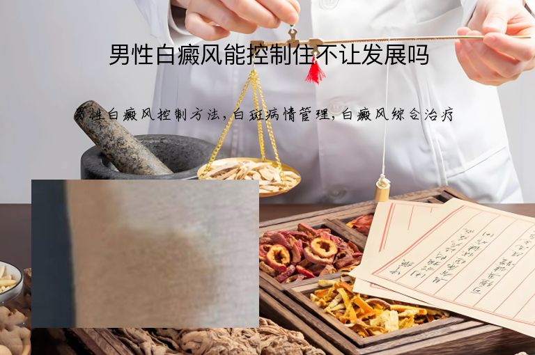 男性白癜风能控制住不让发展吗”