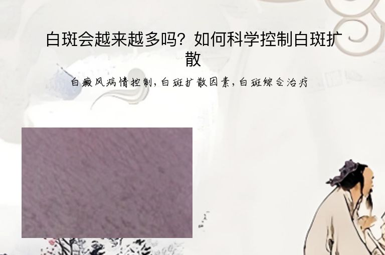 白斑会越来越多吗？如何科学控制白斑扩散”