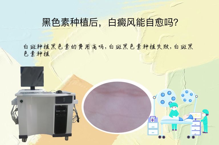 黑色素种植后，白癜风能自愈吗？”