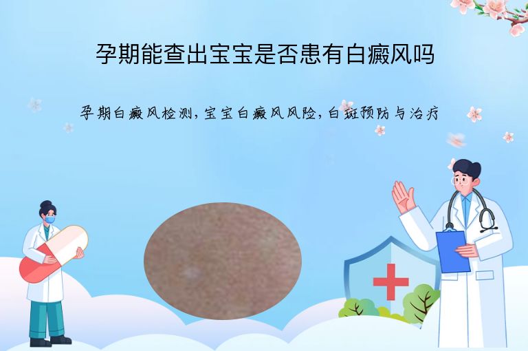 孕期能查出宝宝是否患有白癜风吗”
