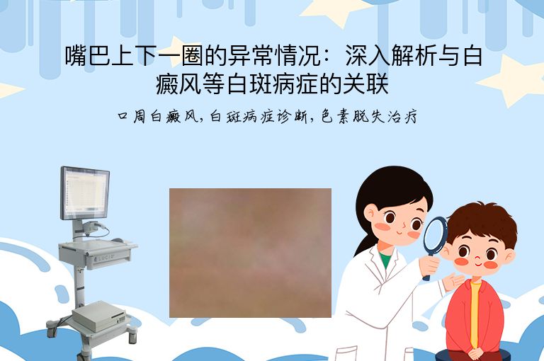 嘴巴上下一圈的异常情况：深入解析与白癜风等白斑病症的关联”