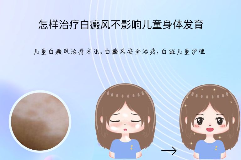 怎样治疗白癜风不影响儿童身体发育”