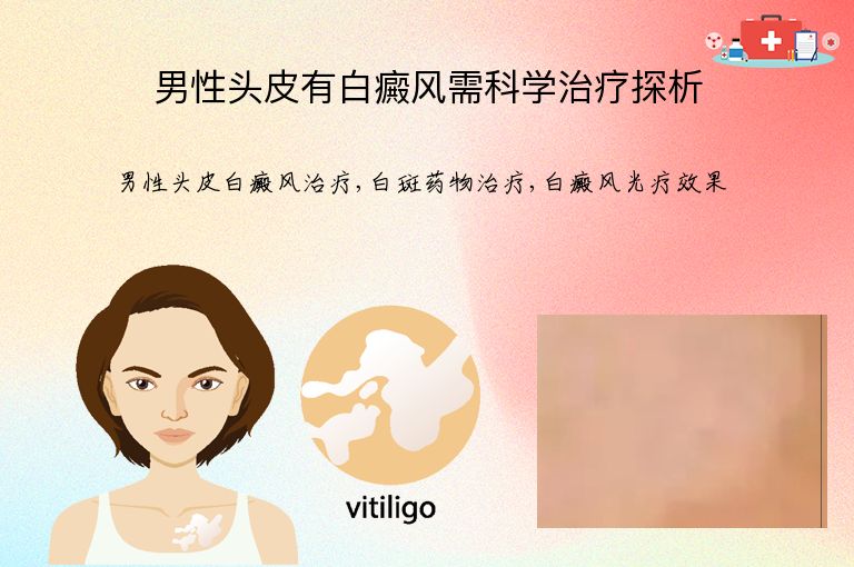 男性头皮有白癜风需科学治疗探析”