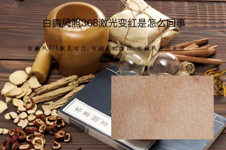 白癜风照308激光变红是怎么回事”
