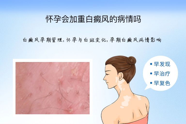 怀孕会加重白癜风的病情吗”