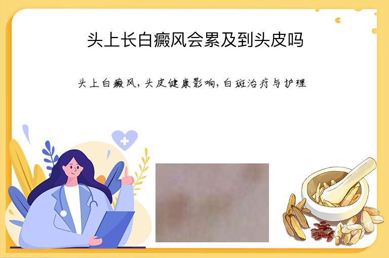 头上长白癜风会累及到头皮吗”