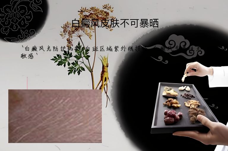 白癜风皮肤不可暴晒