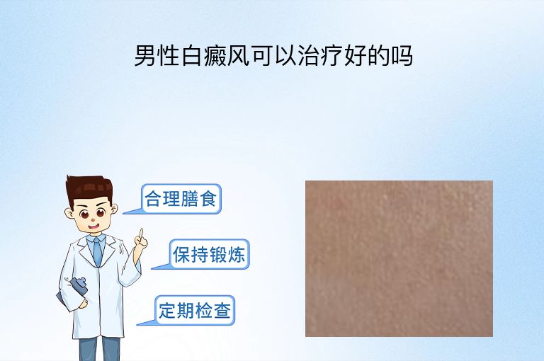 男性白癜风可以治疗好的吗”