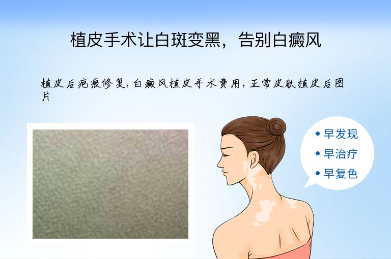 植皮手术让白斑变黑,告别白癜风”