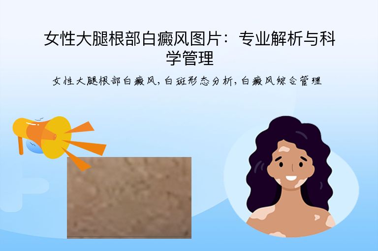 女性大腿根部白癜风图片：专业解析与科学管理”