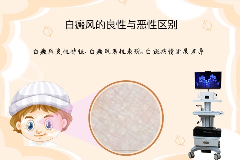 白癜风的良性与恶性区别”