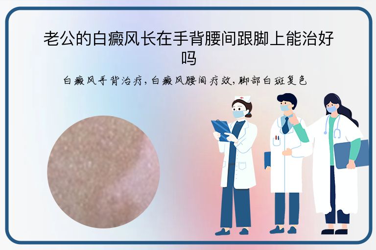 老公的白癜风长在手背腰间跟脚上能治好吗”