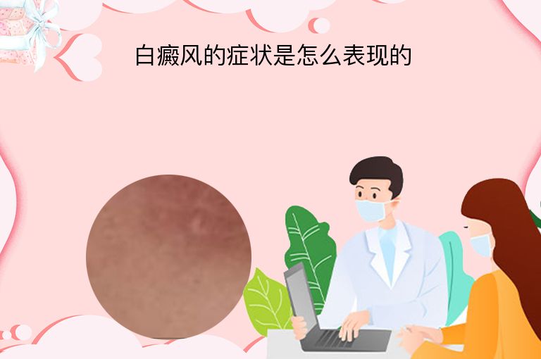 白癜风的症状是怎么表现的