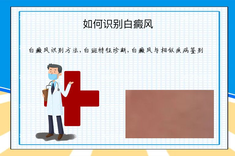 如何识别白癜风”