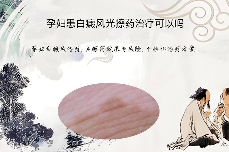 孕妇患白癜风光擦药治疗可以吗”
